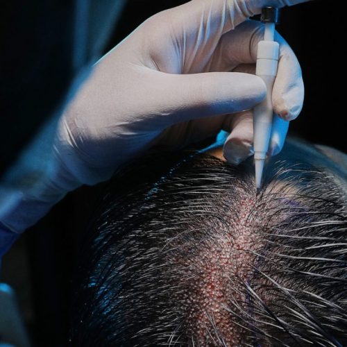 Ongeschoren haartransplantatie in Turkije