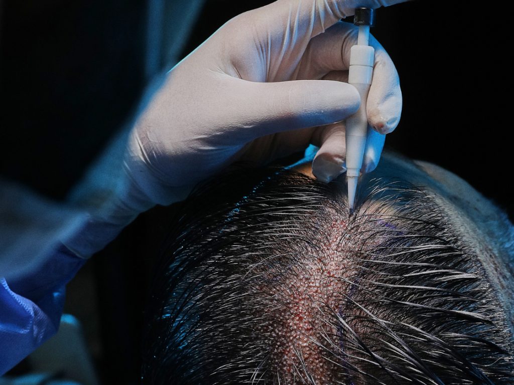 Ongeschoren haartransplantatie in Turkije 1 Ongeschoren haartransplantatie in Turkije