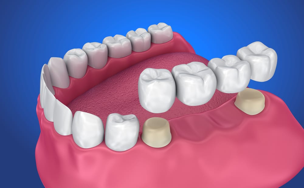 Porcelain Crowns in Turkey 1 Porcelain-Crowns-Turkey