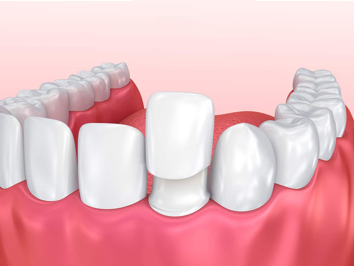 Porcelain Veneers Turkey 1 Porcelain-Veneers-Turkey