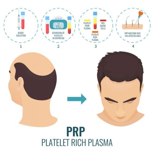 Prp-Treatment-Istanbul