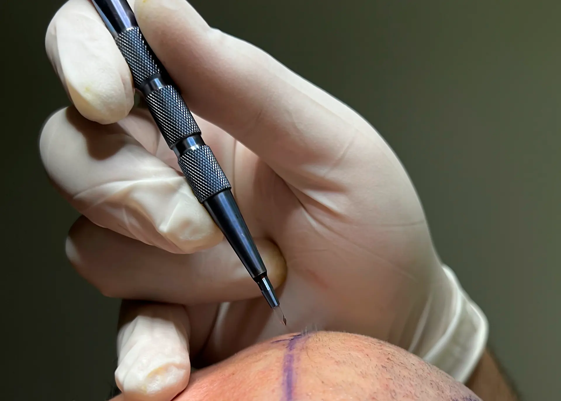 Sapphire Fue Haartransplantatie in Turkije 1 Sapphire Fue Haartransplantatie in Turkije