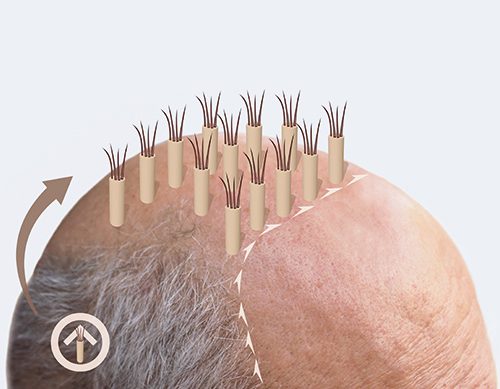 Sapphire-Fue-Haartransplantation-in-Der-Turkei