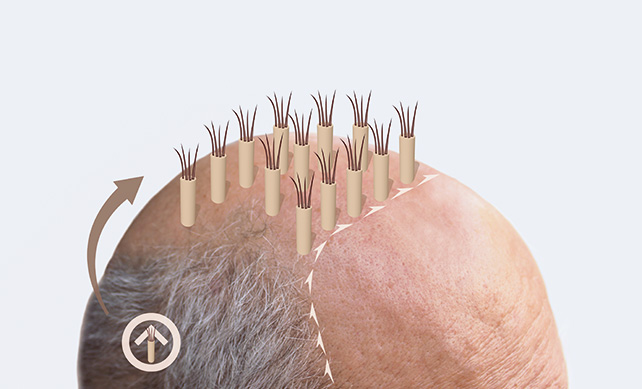 Sapphire-Fue-Haartransplantation-in-Der-Turkei