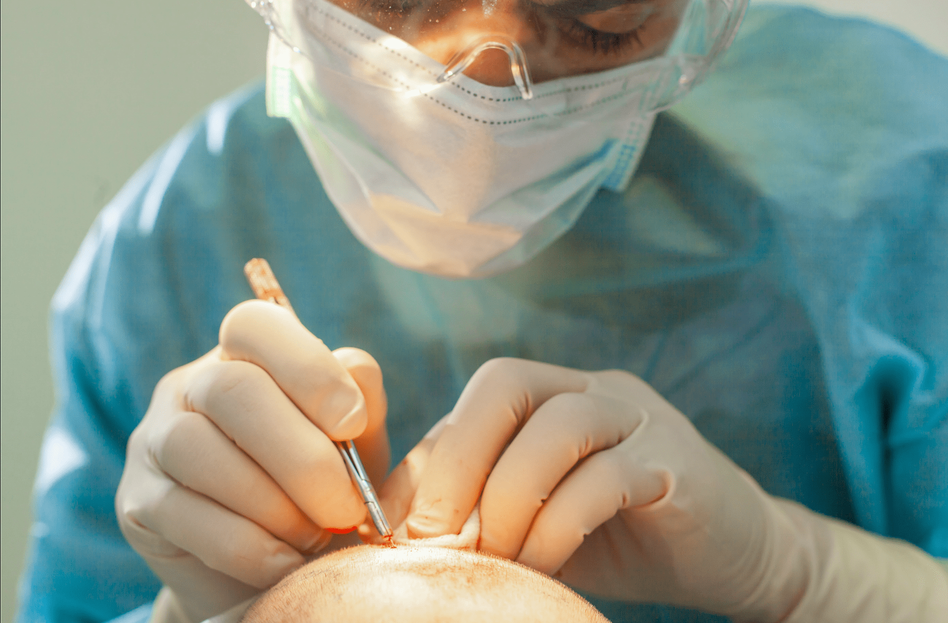 Stamcel haartransplantatie in Turkije 1 Stamcel haartransplantatie in Turkije