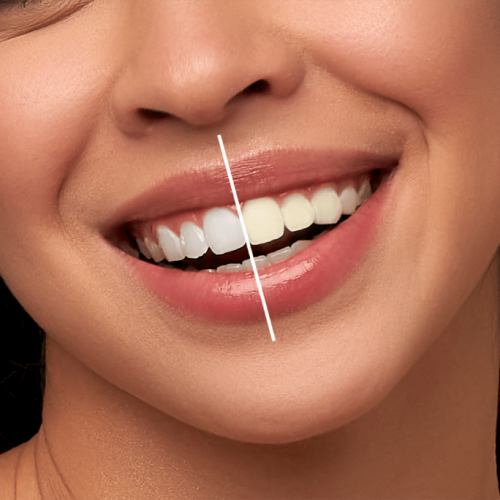 Teeth-Whitening-turkey