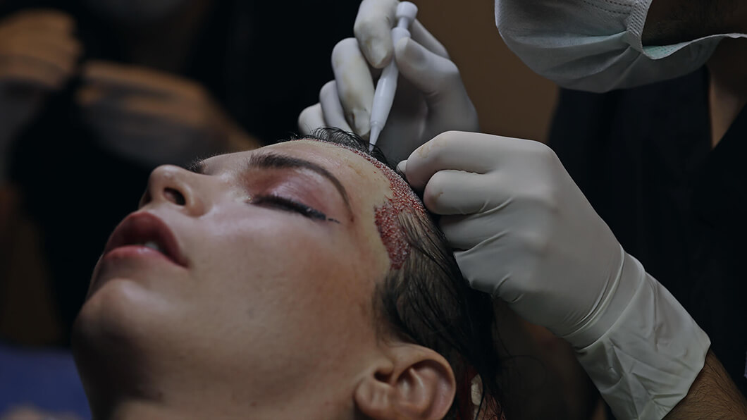 Trapianto di capelli U-FUE Turchia 1 Trapianto di capelli U-FUE Turchia