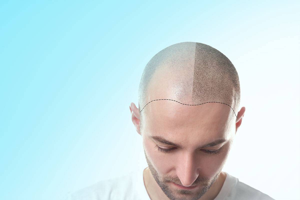 Trasplante Capilar 1 Trasplante Capilar