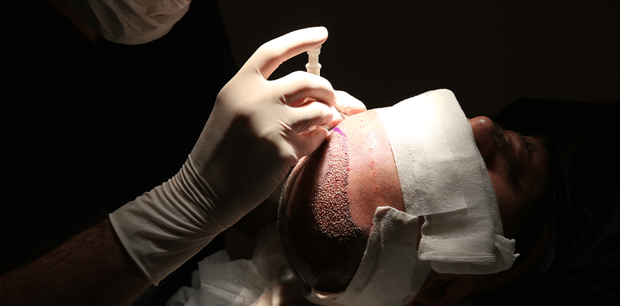 Trasplante capilar DHI en Turquía 1 Trasplante capilar DHI en Turquía