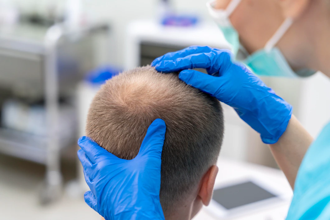 U-FUE Haartransplantation In Der Türkei 1 U-FUE-Haartransplantation-Turkei