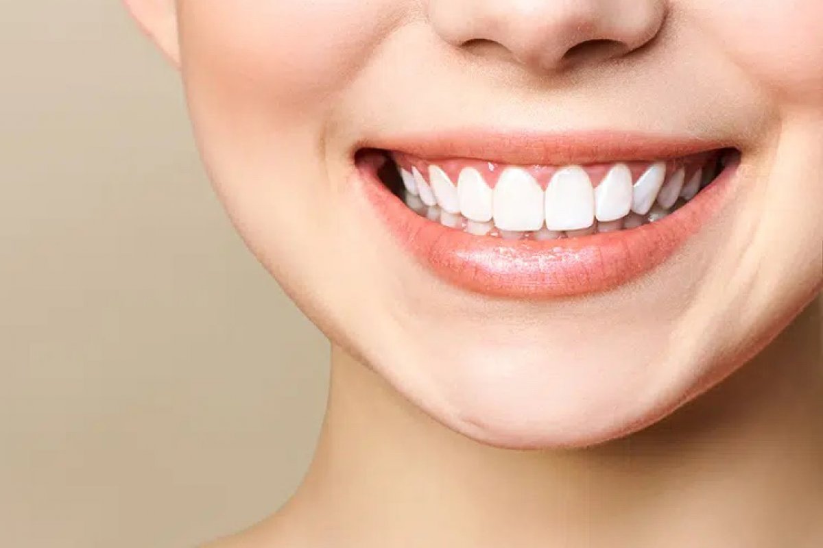 Zahnfleischlächeln in der Türkei 1 Zahnfleischlacheln-in-der-Turkei
