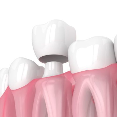 Zirconium-Crowns-Turkey