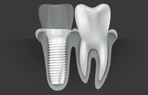 Zirconium-Dental-Implants-turkey.