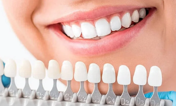 Zirkonium kronen in Turkije 1 Zirkonium kronen in Turkije