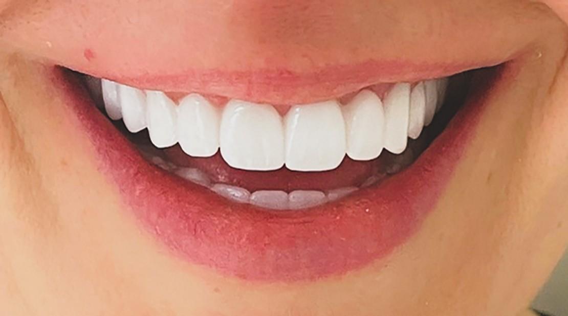 Zirkonkronen in der Türkei 1 Zirkonkronen-in-der-Turkei