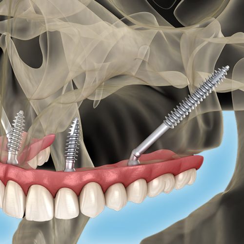 Zygomatic-Dental-Implants-turkey