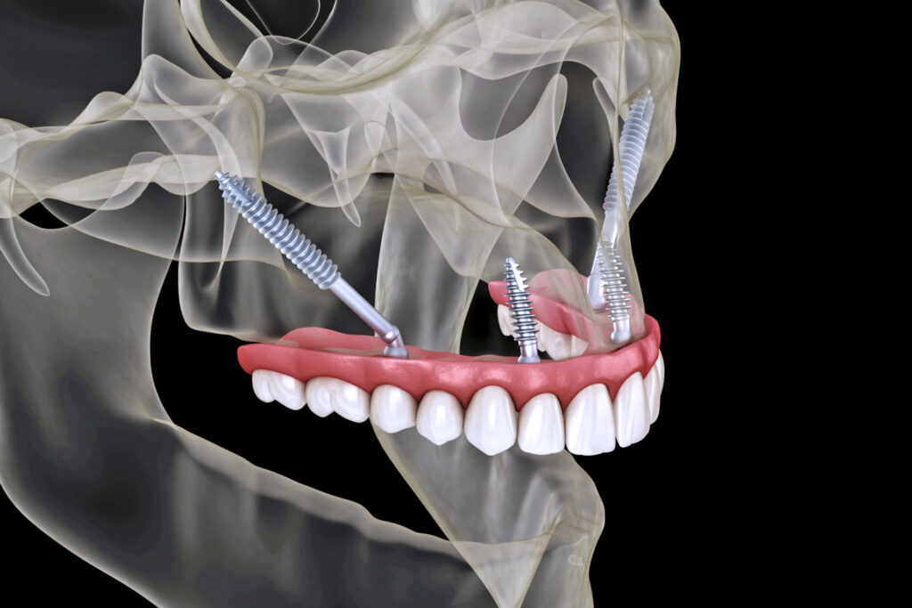Zygomatische tandheelkundige implantaten in Turkije 1 Zygomatische tandheelkundige implantaten in Turkije