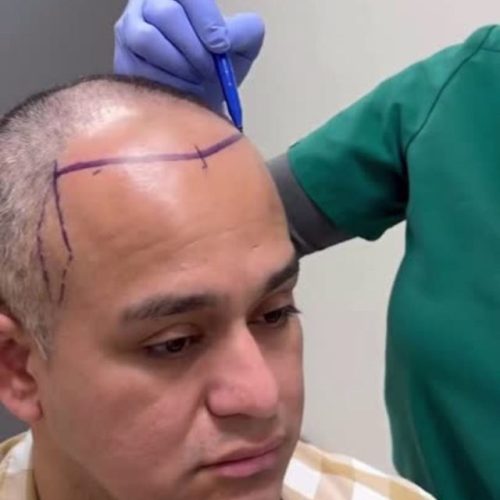 4500 Grafts Hair Transplant