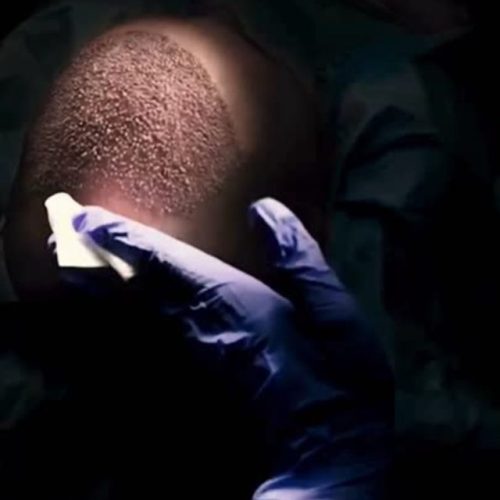 3500 Grafts Hair Transplant