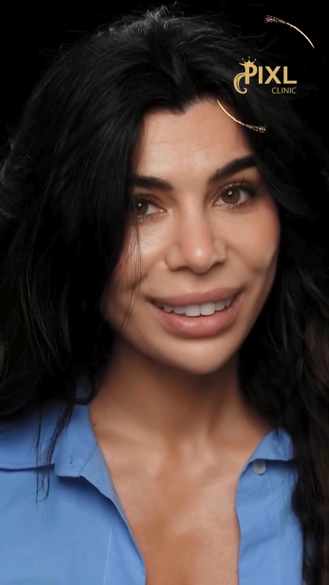 Lumineers En Turquie : Sourire Parfait à Prix Abordable, image size:1080x1920