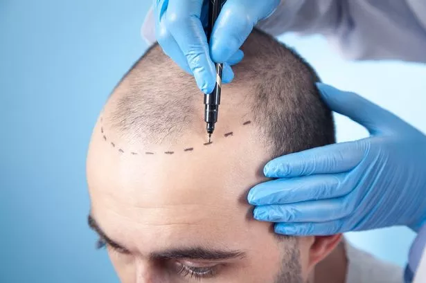 Hair Transplant in Turkey 1 hair-transplant-in-turkey