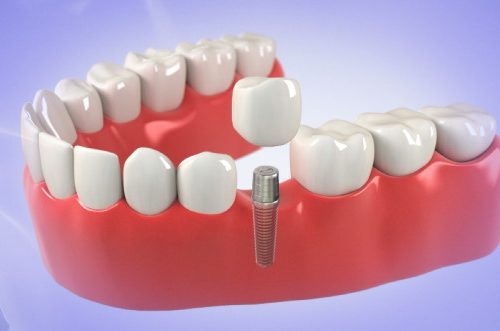 immediate-Dental-Implants-turkey.