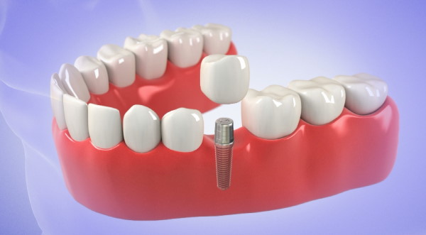 Immediate Implants Turkey 1 immediate-Dental-Implants-turkey.