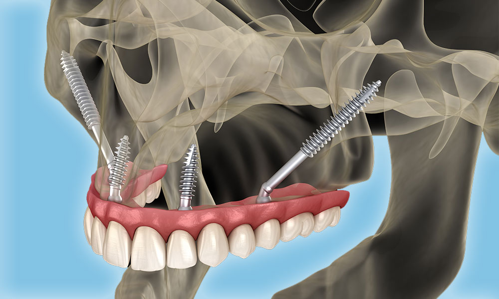 Зубные имплантаты Zygomatic в Турции 1 Зубные-имплантаты-Zygomatic-в-Турции.