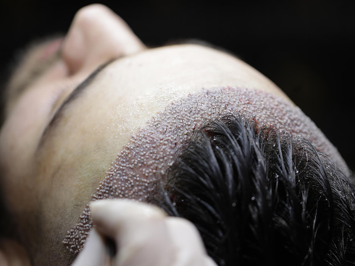 Пересадка небритых волос Турция 1 Пересадка небритых волос Турция