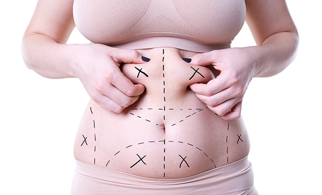 360 Liposuction 1 360-Liposuction