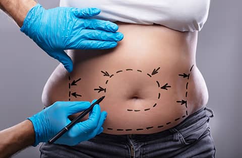 Abdominoplastia en Turquía