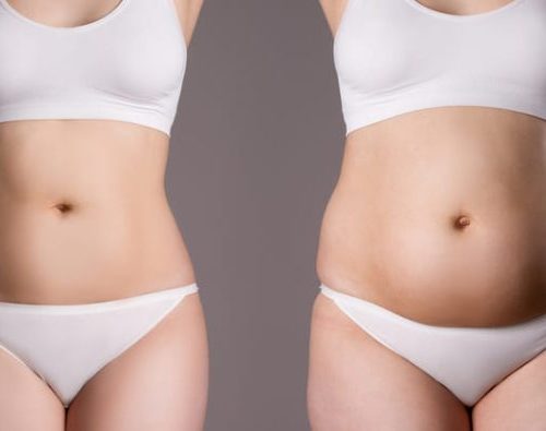 Abdominoplastie en Turquie