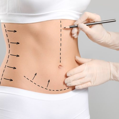 Abdominoplasty-in-Turkey