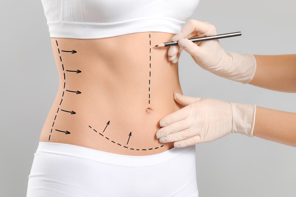 Abdominoplasty in Turkey 1 Abdominoplasty-in-Turkey