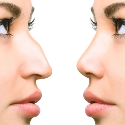 Asian-Rhinoplasty-in-Turkey