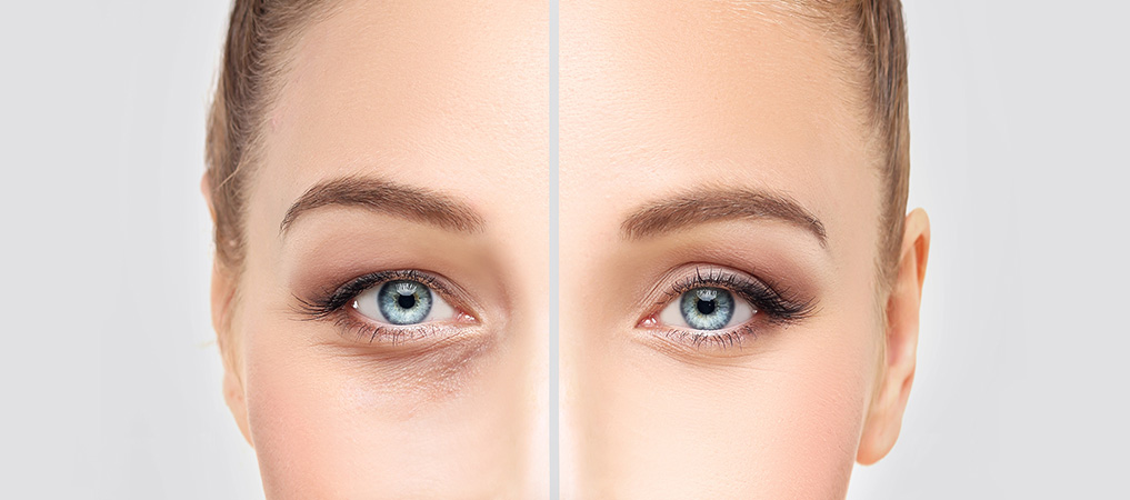 Blépharoplastie en Turquie 1 Blépharoplastie en Turquie