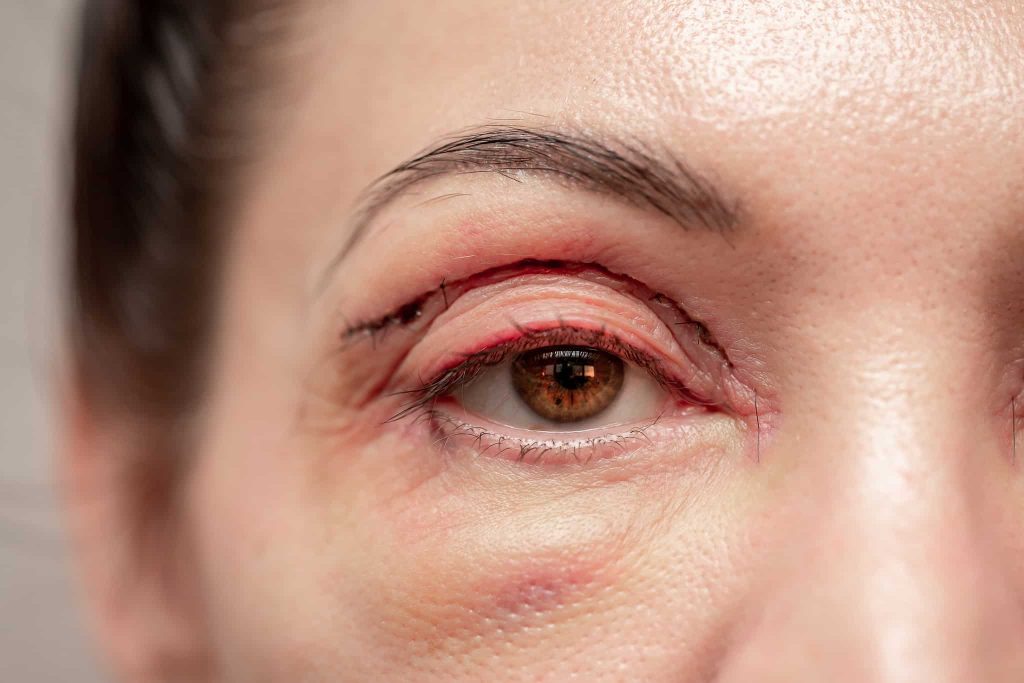 Blepharoplastie in Turkije