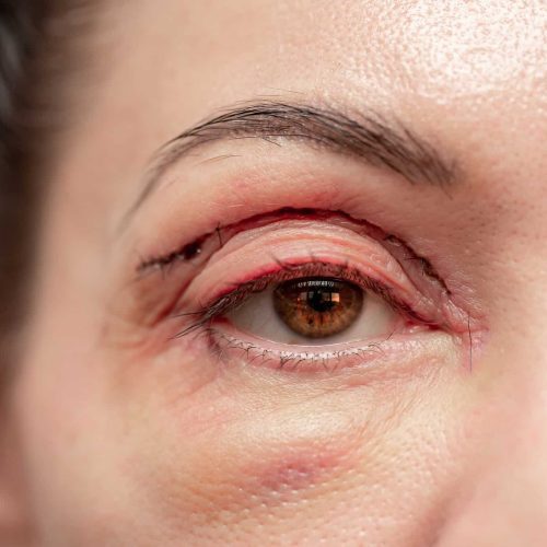 Blepharoplastie in Turkije