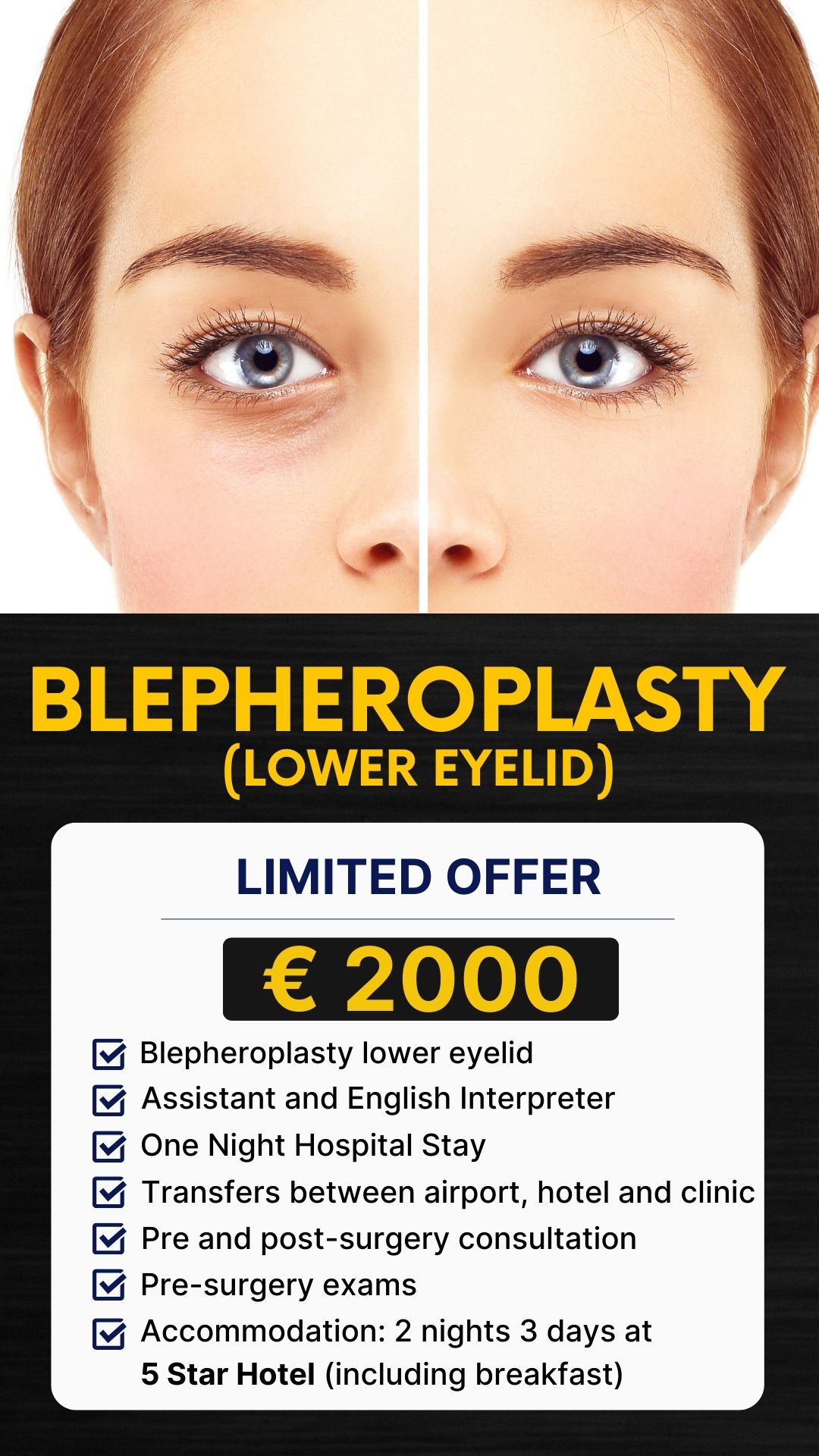 Blepheroplasty