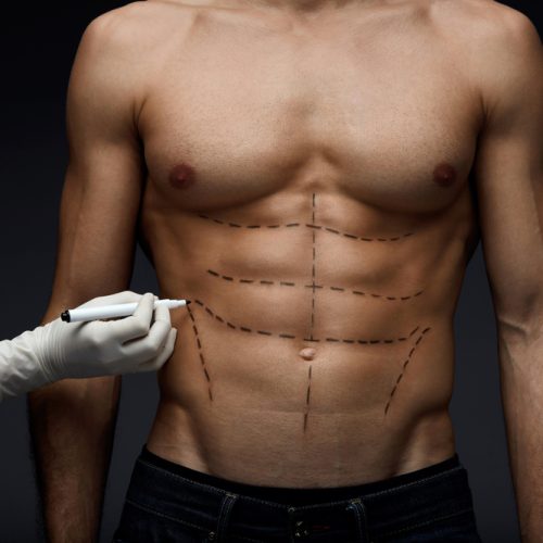 Chirurgie-Six-Pack-en-Turquie