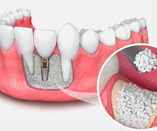 Dental-Kemik-Grefti