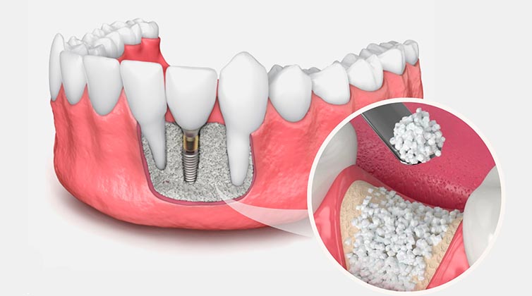 Dental-Kemik-Grefti