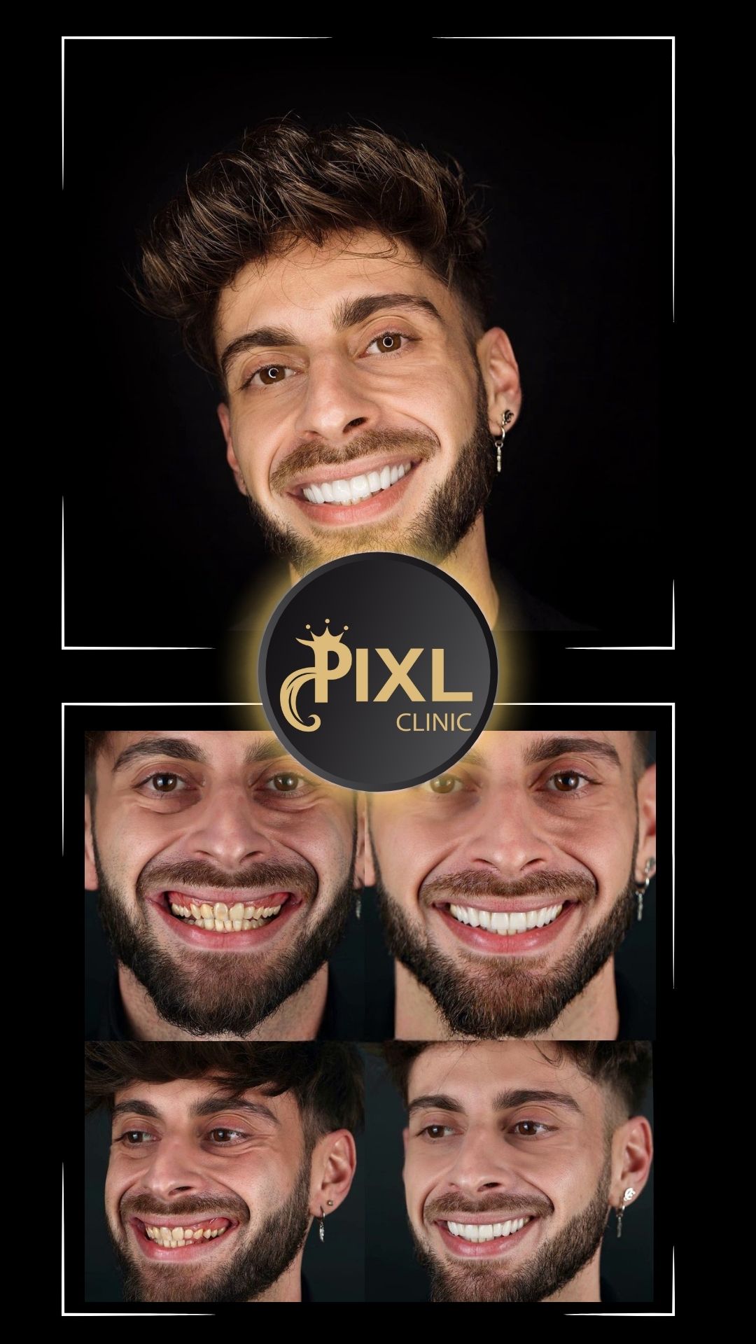 HOLLYWOOD-SMILE-BEFORE-AFTER