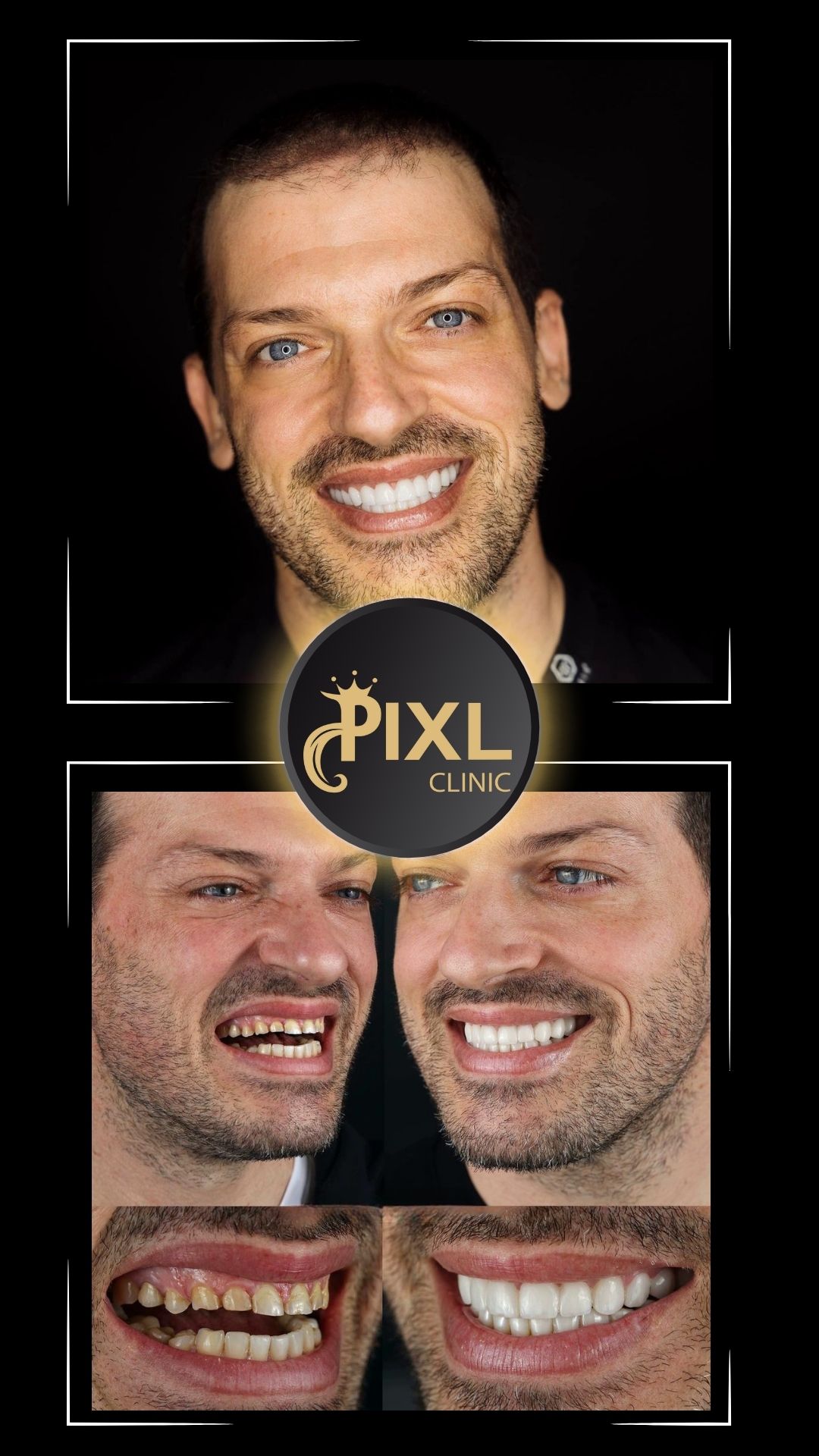 HOLLYWOOD-SMILE-BEFORE-AFTER