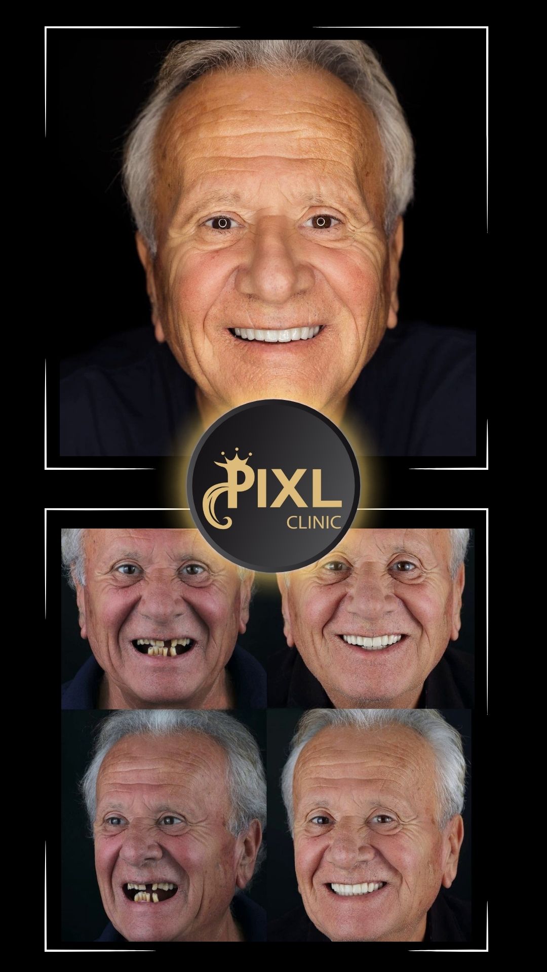 HOLLYWOOD-SMILE-BEFORE-AFTER