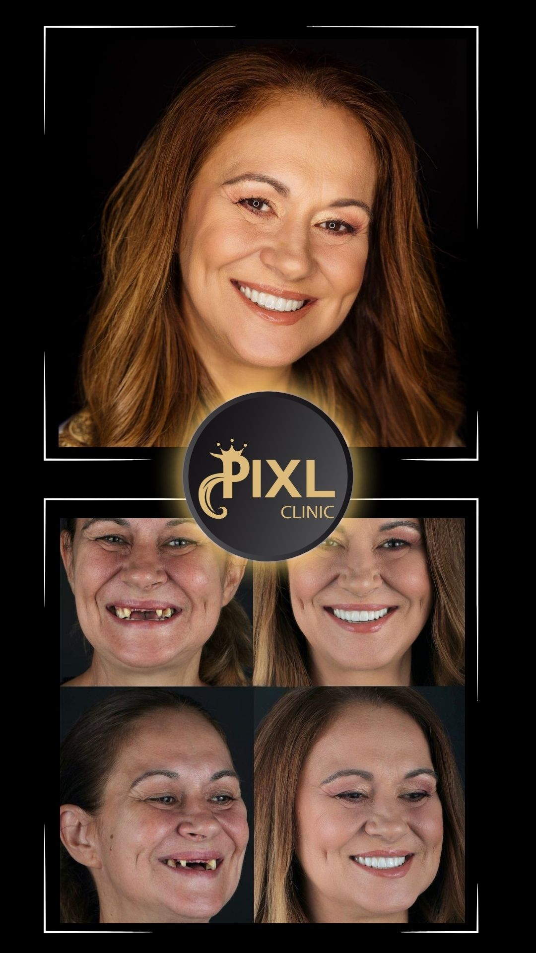 HOLLYWOOD-SMILE-BEFORE-AFTER