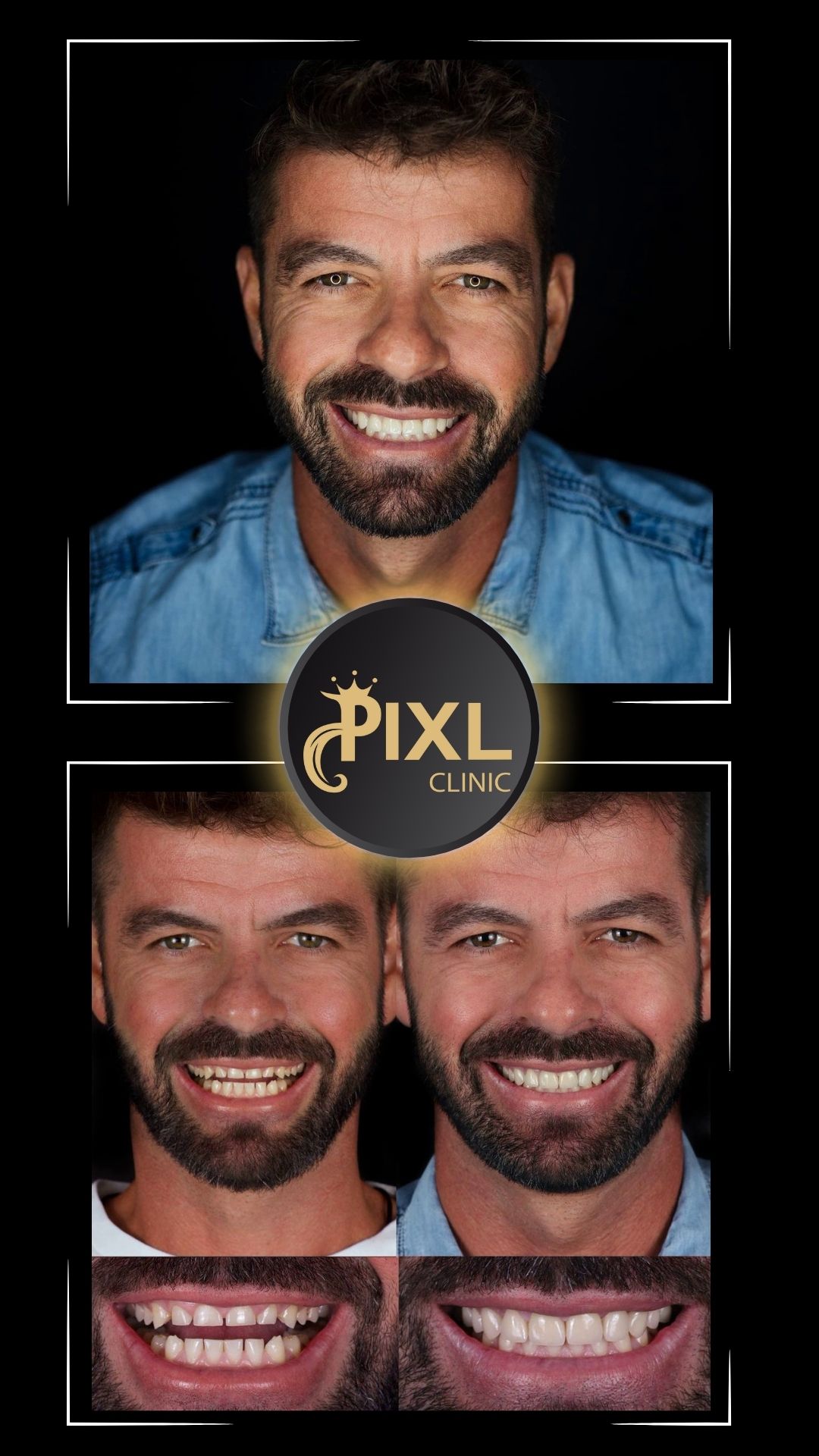 HOLLYWOOD-SMILE-BEFORE-AFTER