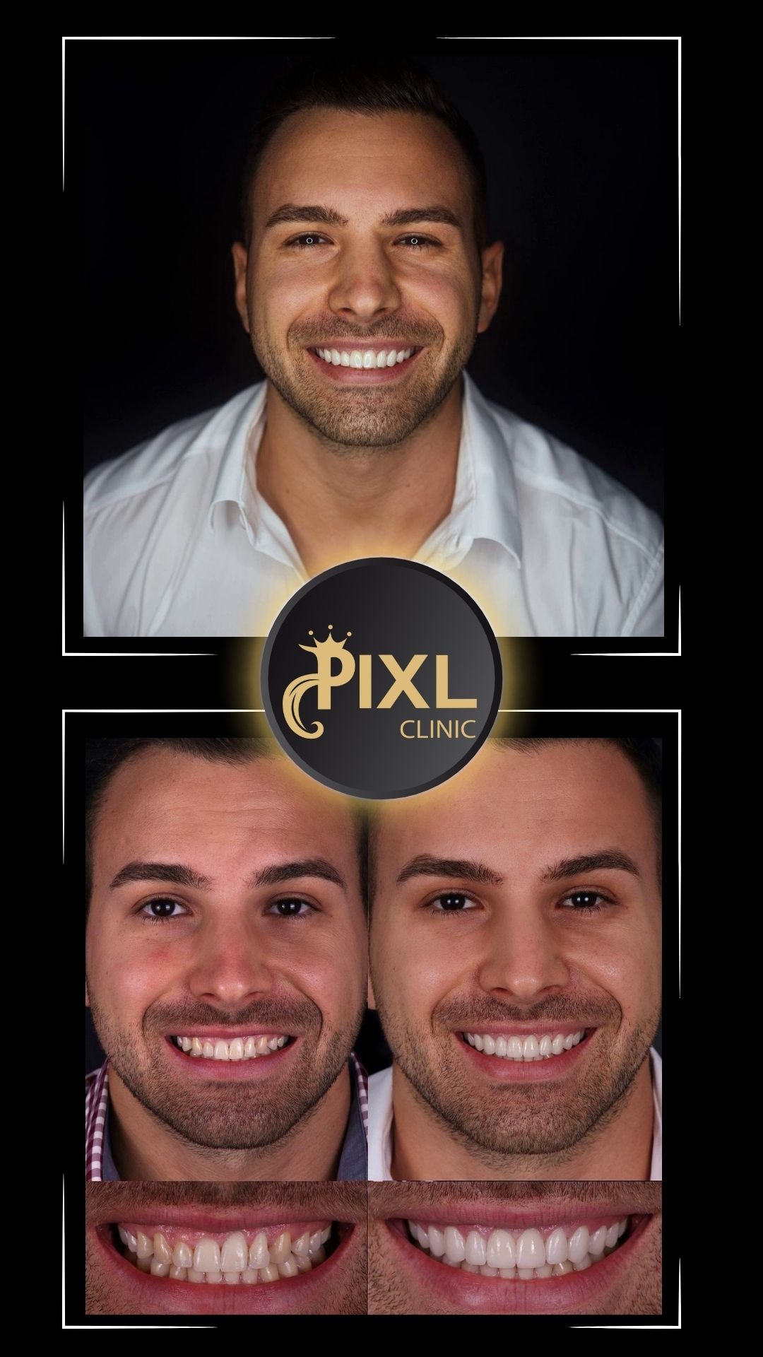 HOLLYWOOD-SMILE-BEFORE-AFTER