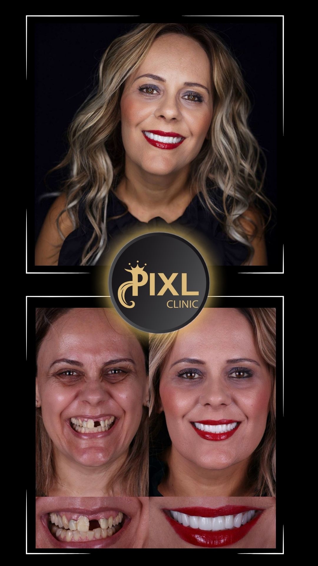 HOLLYWOOD-SMILE-BEFORE-AFTER