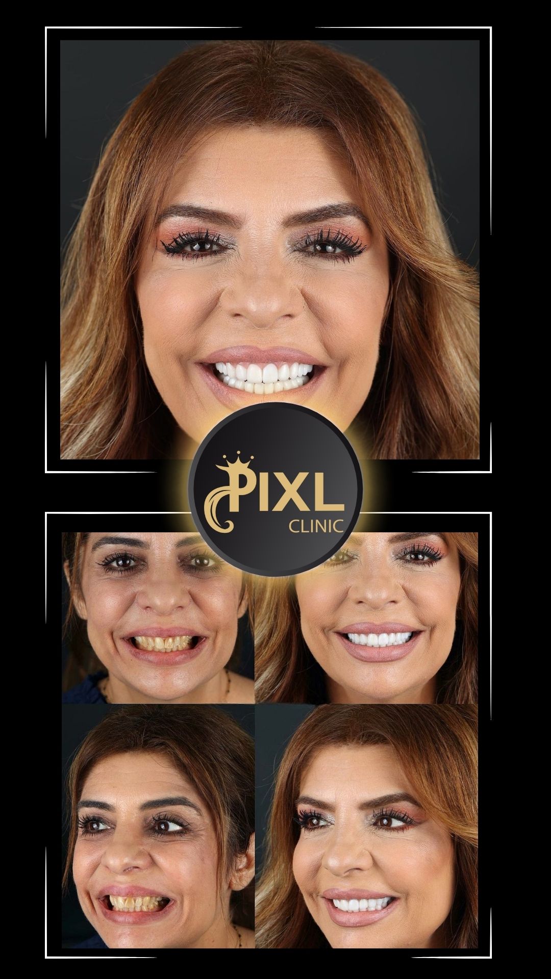 HOLLYWOOD-SMILE-BEFORE-AFTER